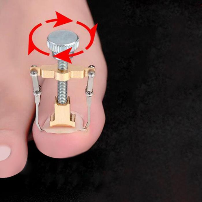 Ingrown Toenail Removal Without Pain