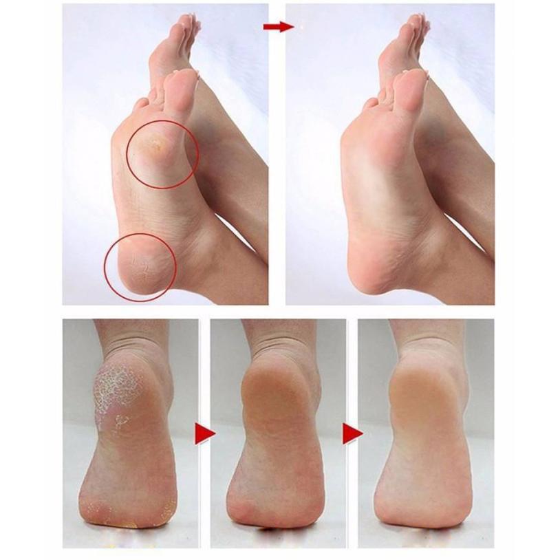 Feet Callus Remover