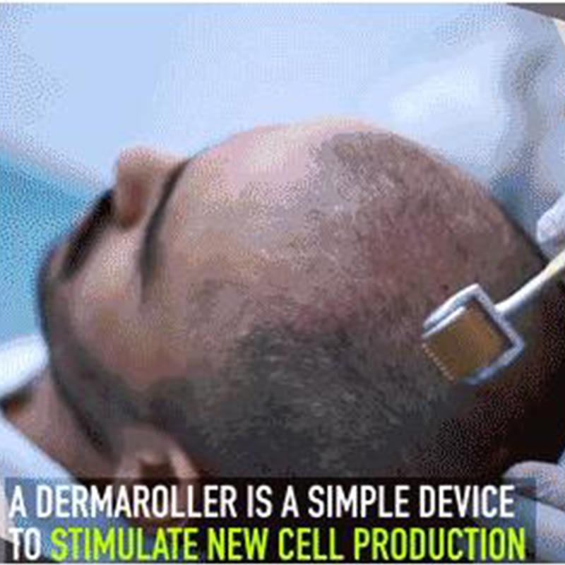 Premium Titanium Microneedle Derma Roller