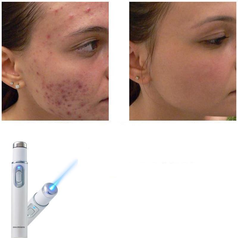 Laser Skin Treatment