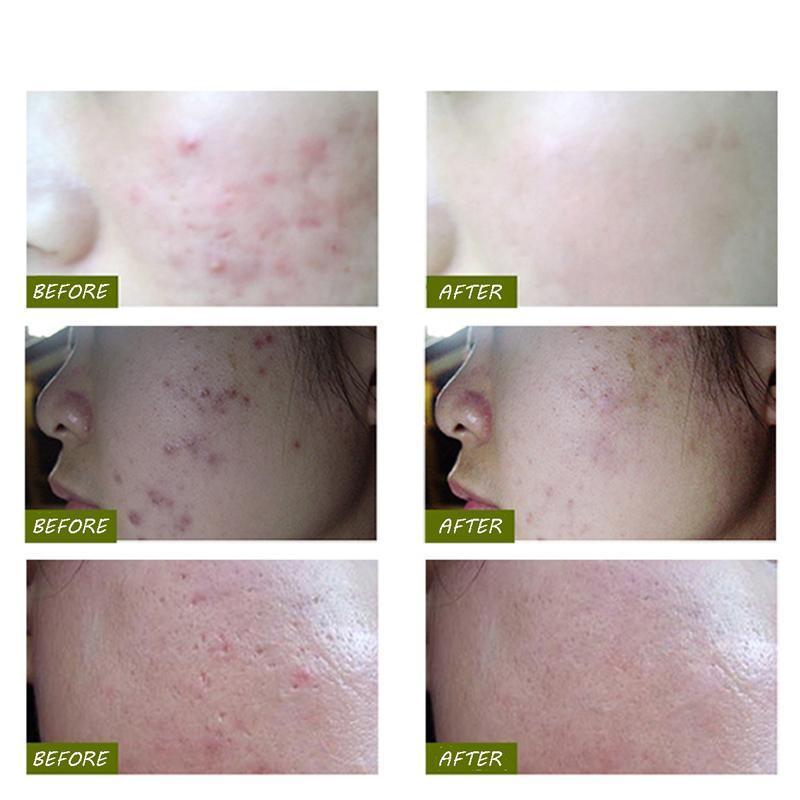 Laser Skin Treatment