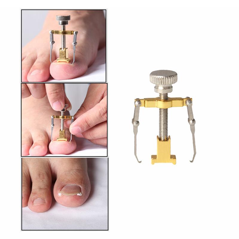 Ingrown Toenail Removal Without Pain