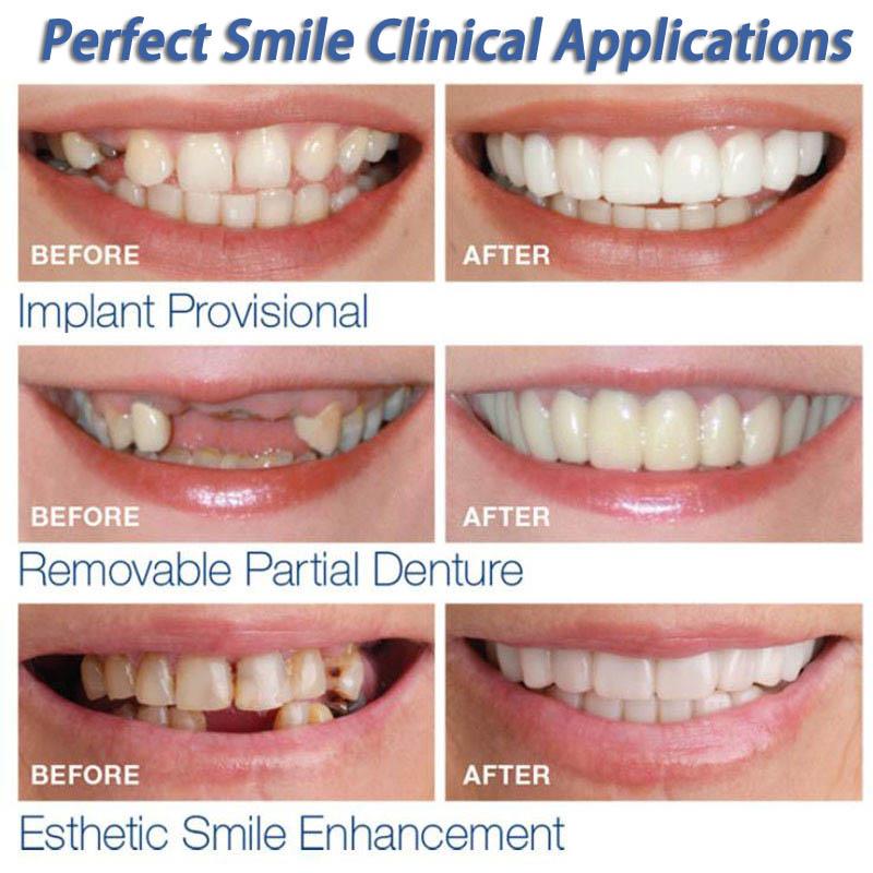 2 Pcs Snap on Veneers (Upper and Lower)