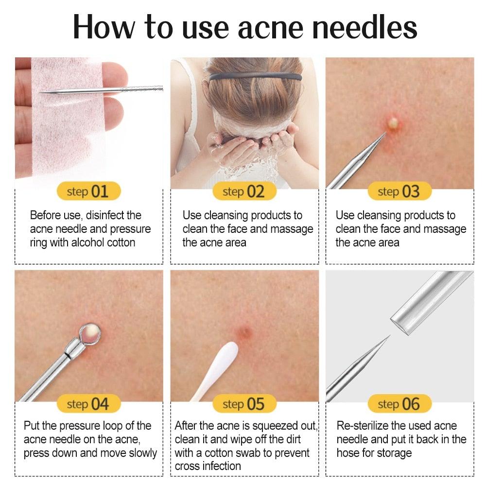 Blackhead and Acne Remover Skin Tools