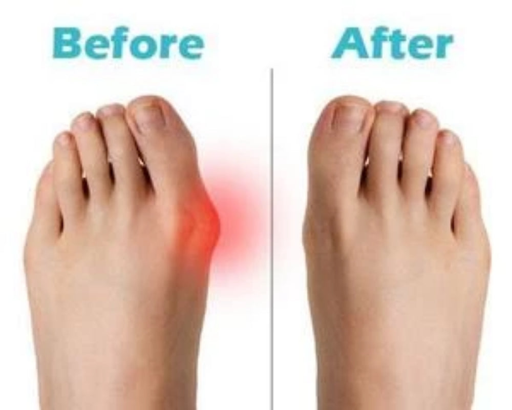Orthopedic Bunion Corrector 2.0
