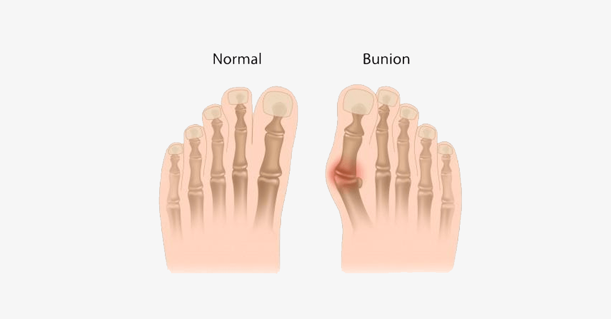 Comfort Healing Toe Separators and Bunion Spacers
